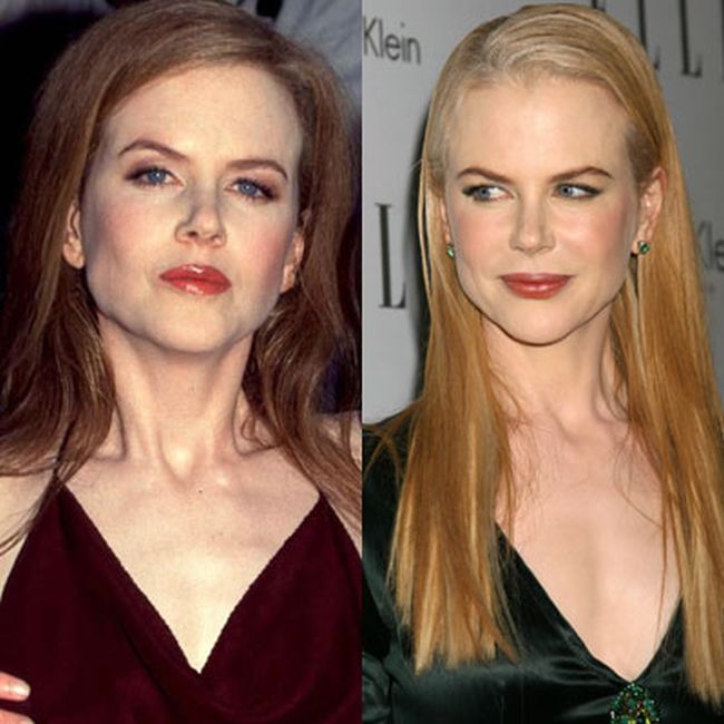 Nicole Kidman Plastic Surgery Photos Before Amp After Surgery4 Nicole Kidman Plastic Surgery Photos Before Amp After Surgery4